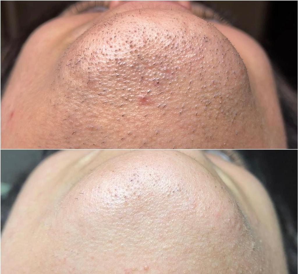 EpilStar — efekt zabiegu 1